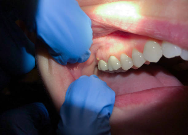 Best Emergency Tooth Extraction in Imperial, NE